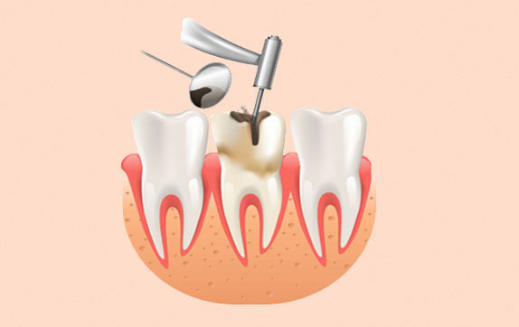 فیشور سیلانت یا پر کردن شیار دندان