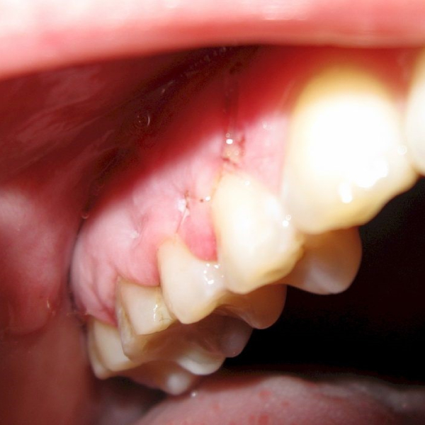 تشخیص کیست دندان