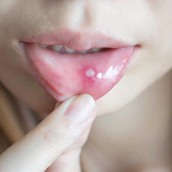causes-and-treatment-of-canker-sores