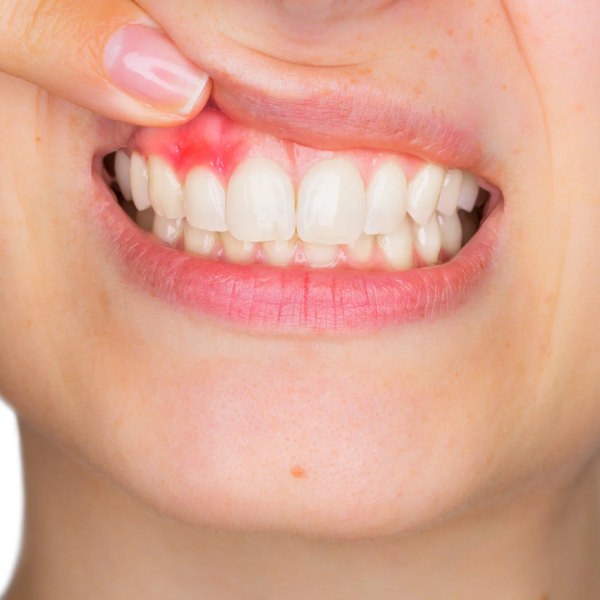 causes-and-treatment-of-canker-sores2