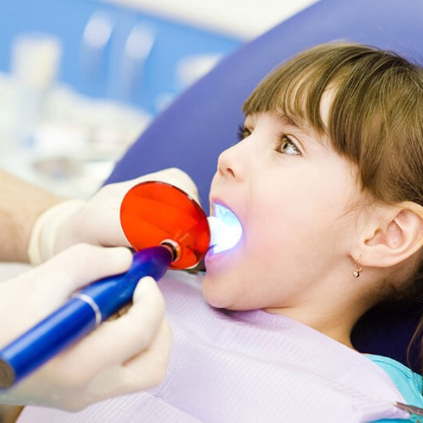 فیشور سیلانت یا پر کردن شیار دندان چگونه اعمال می‌شود؟