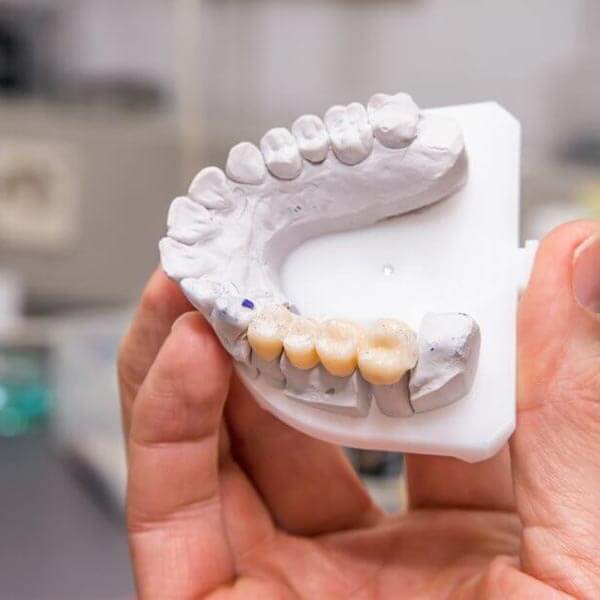 قالب گیری دندان به روش سنتی