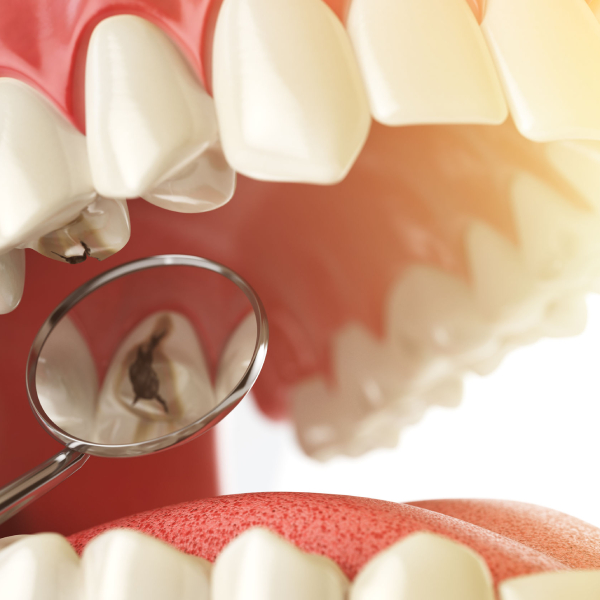 پیشگیری از تسوس دندان