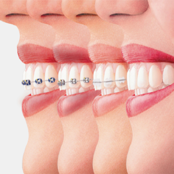 نکات انتخاب درست انواع ارتودنسی دندان